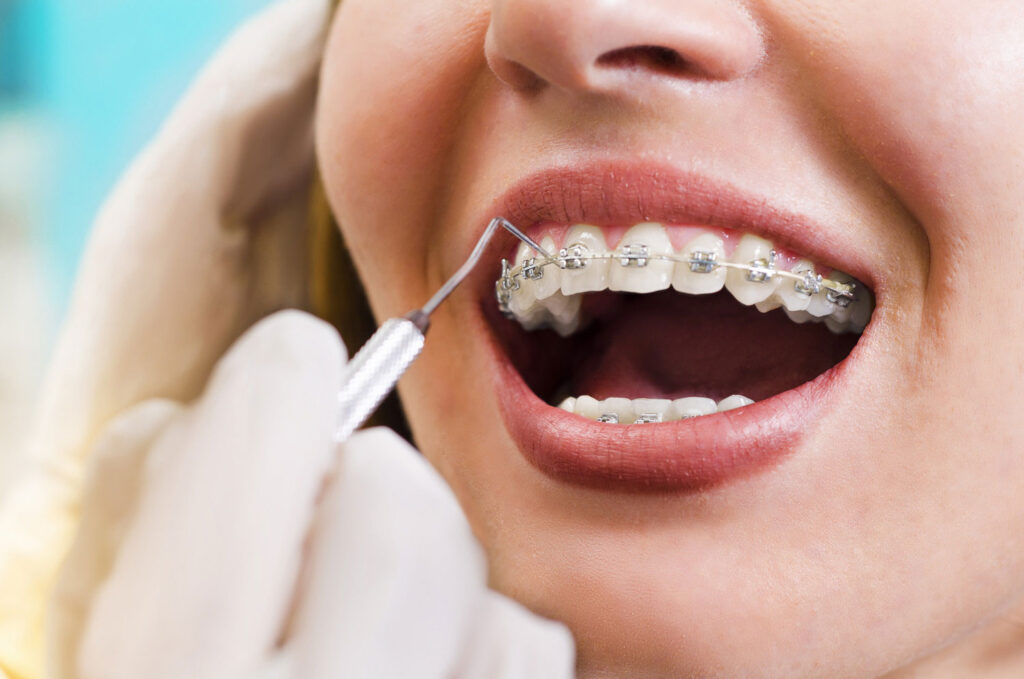 manfaat kawat gigi - klinik gigi sozo dental