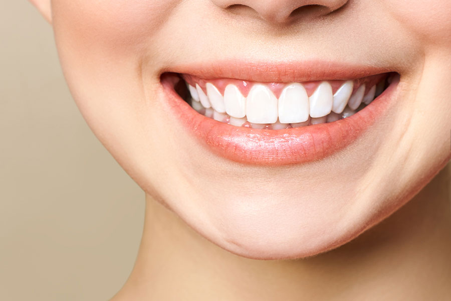 perawatan gigi sozo dental - bleaching gigi