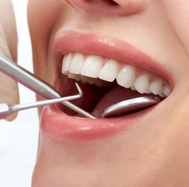 perawatan gigi sozo dental - scaling gigi