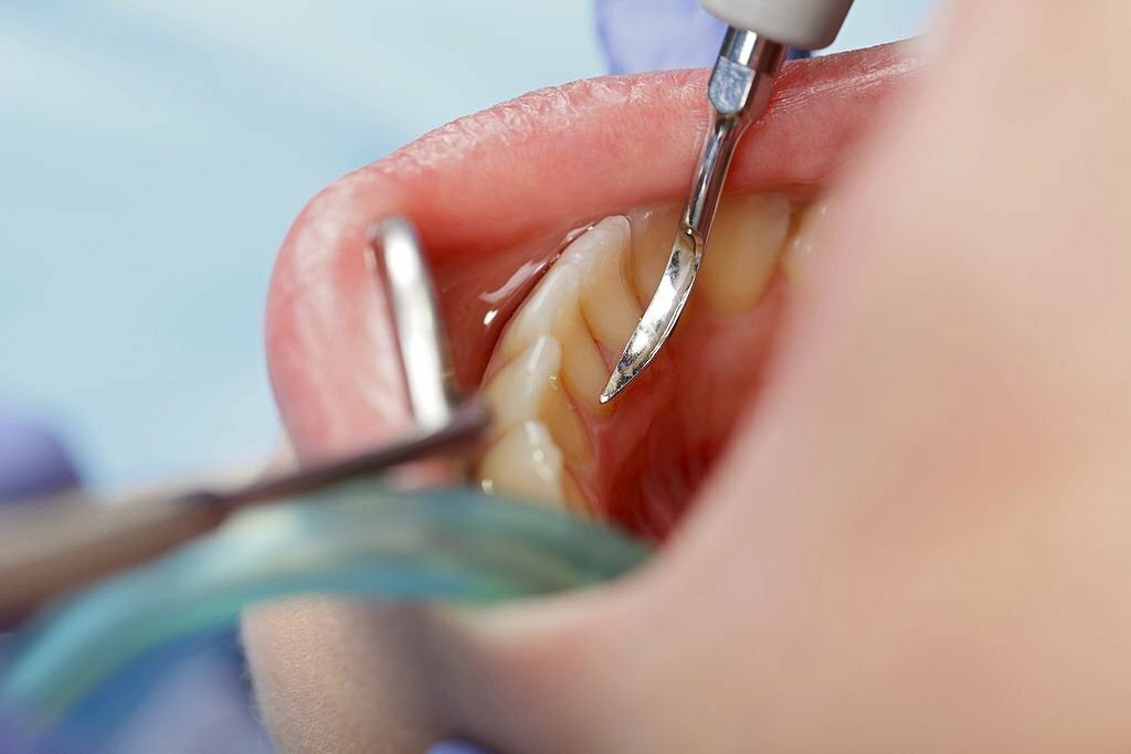 cara mencegah karang gigi menumpuk - klinik gigi sozo dental