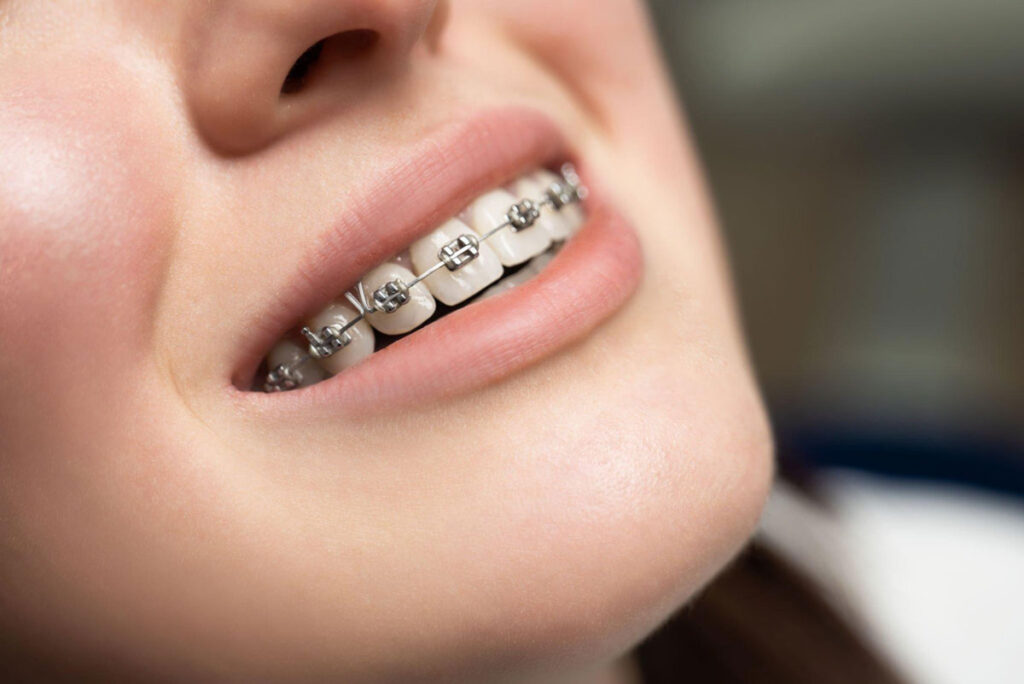 pasawang kawat gigi sakit - tips ampuh meredakan nyeri - klinik gigi sozo dental