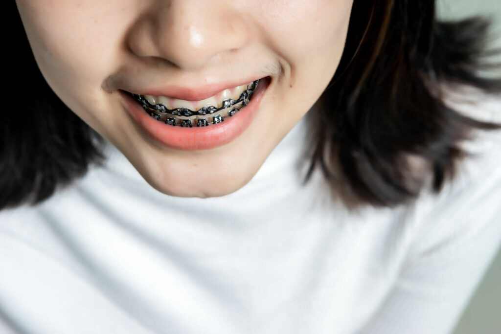 tantangan saat pakai behel - klinik gigi sozo dental