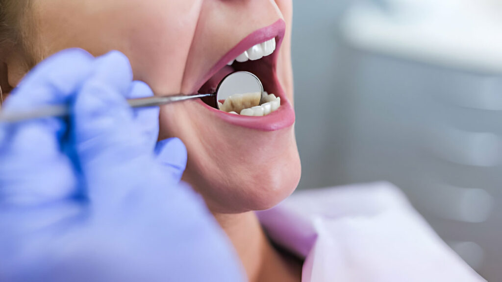 kapan harus membersihkan karang gigi - klinik gigi sozo dental