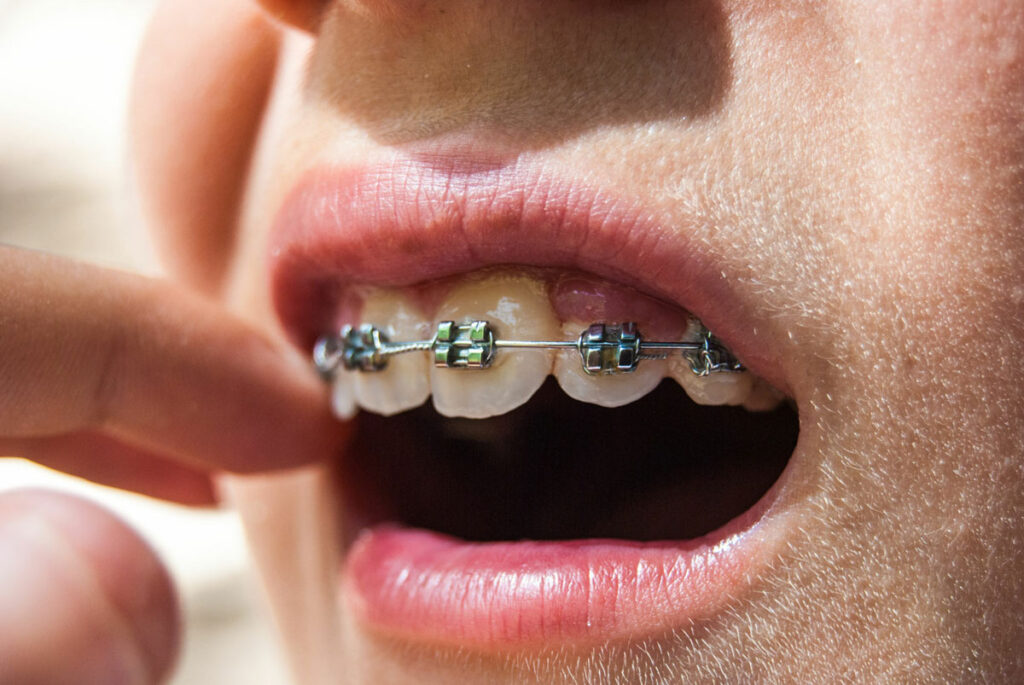 pasang behel harus cabut gigi - klinik gigi sozo dental