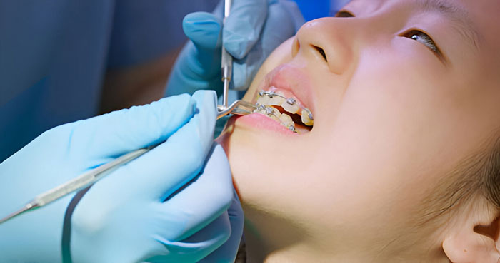 Prosedur Pemasangan Behel di Sozo Dental