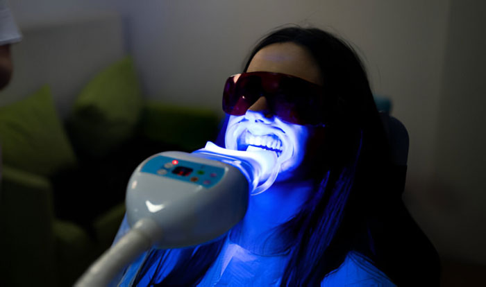 Treatment Bleaching Gigi Sozo Dental