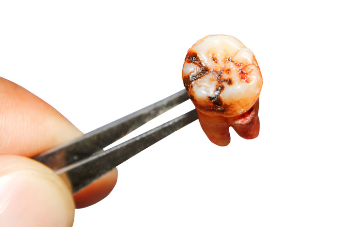 alasan cabut gigi di klinik sozo dental