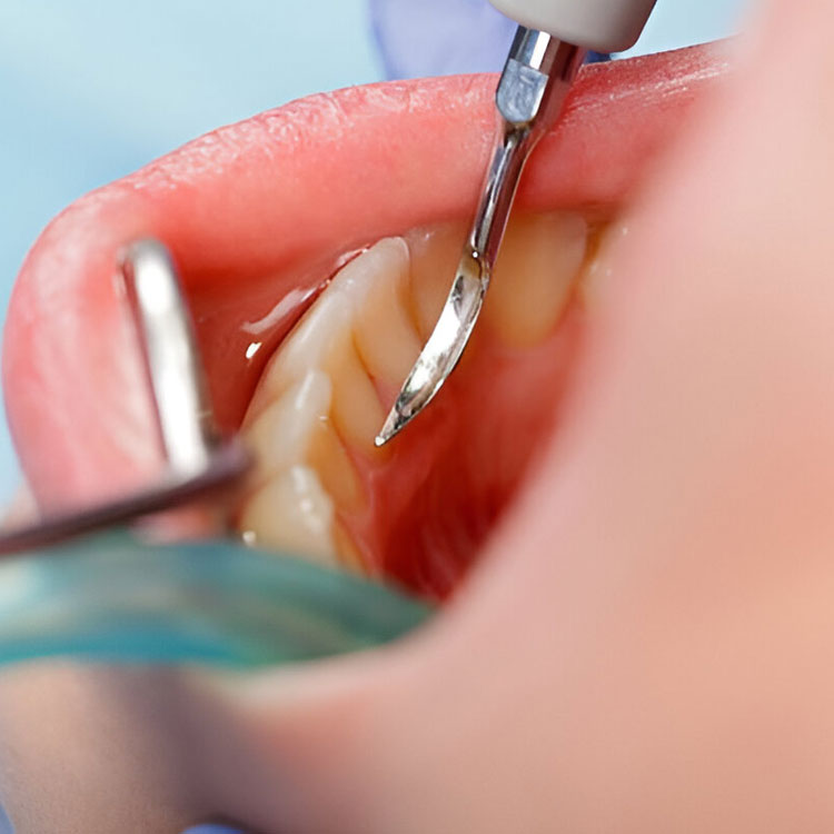 basic scaling gigi - klinik gigi sozo dental