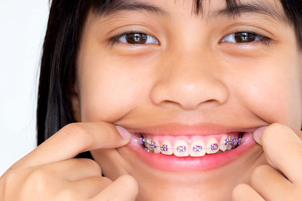 penyebab gigi overbite - konsultasi pasang behel di sozo dental