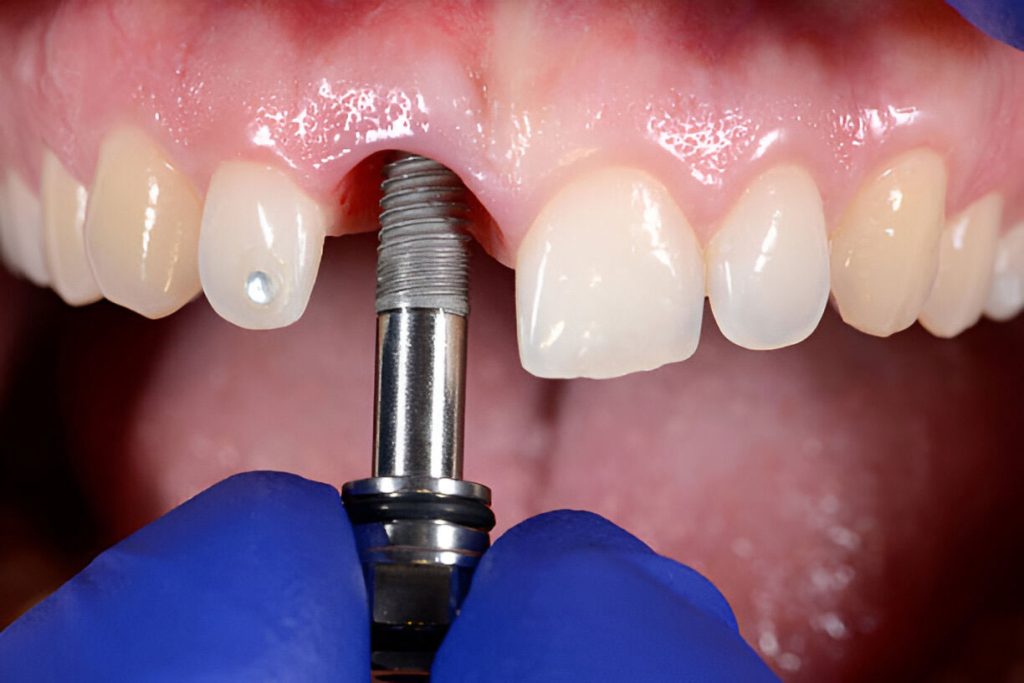 pasang implan gigi di sozo dental