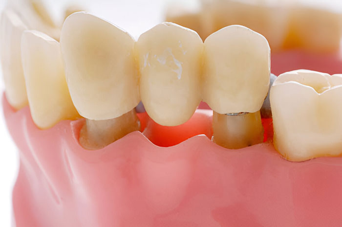 pemasangan gigi palsu - dental bridge