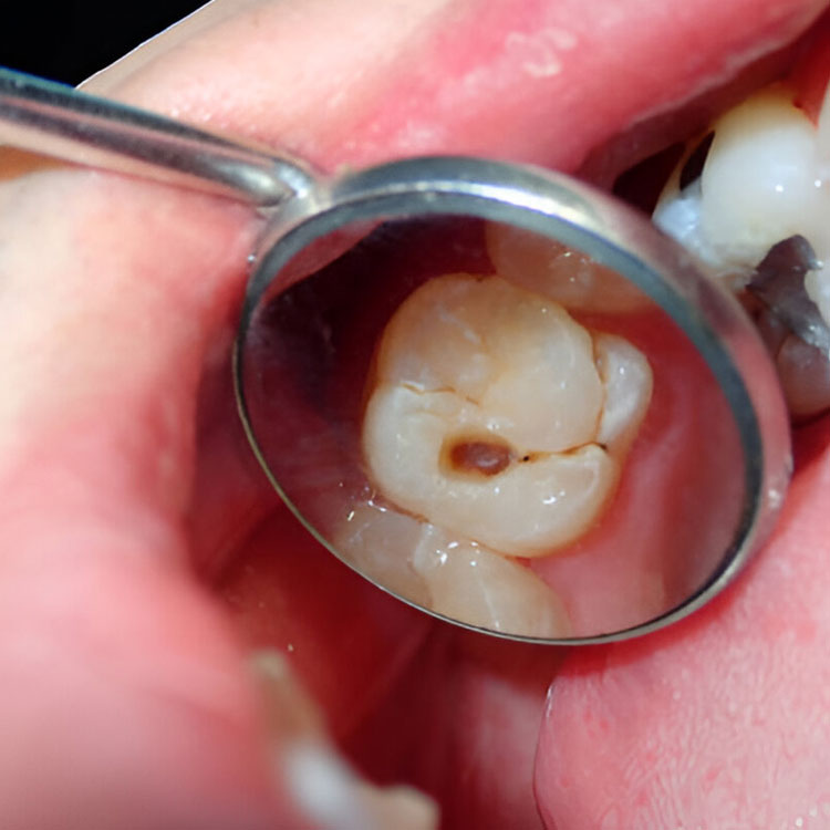 tambal gigi belakang - klinik gigi sozo dental