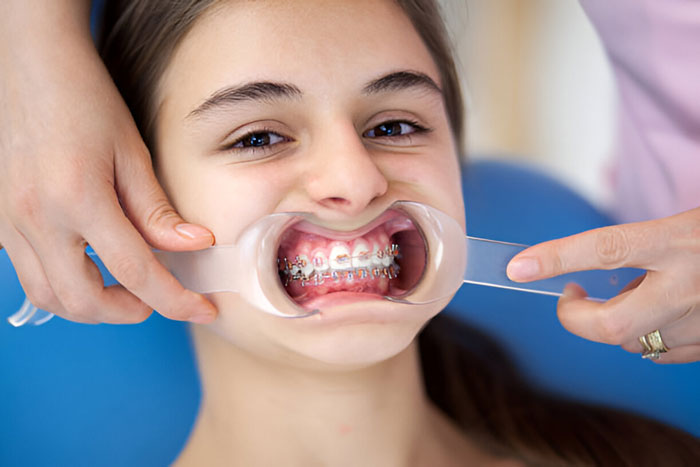 transparansi biaya pemasangan behel sozo dental