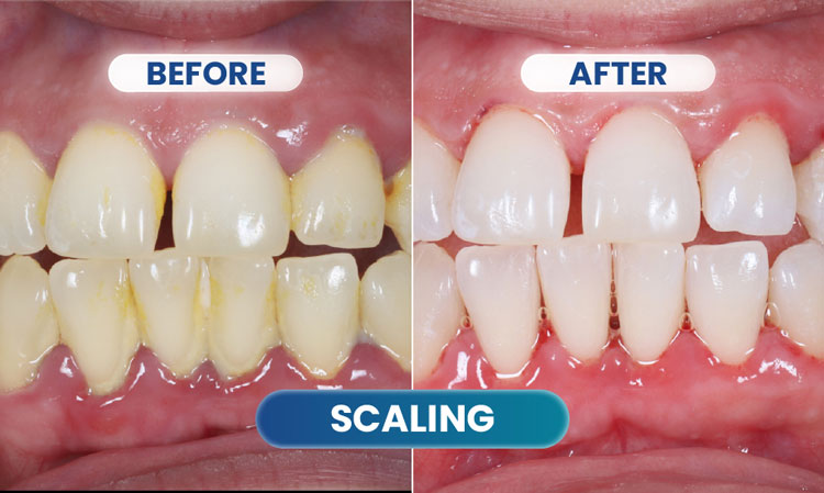 before after scaling 3 - klinik gigi sozo dental