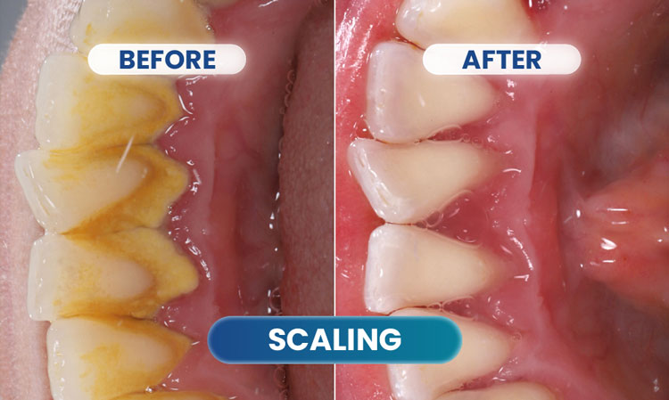 before after scaling 4 - klinik gigi sozo dental