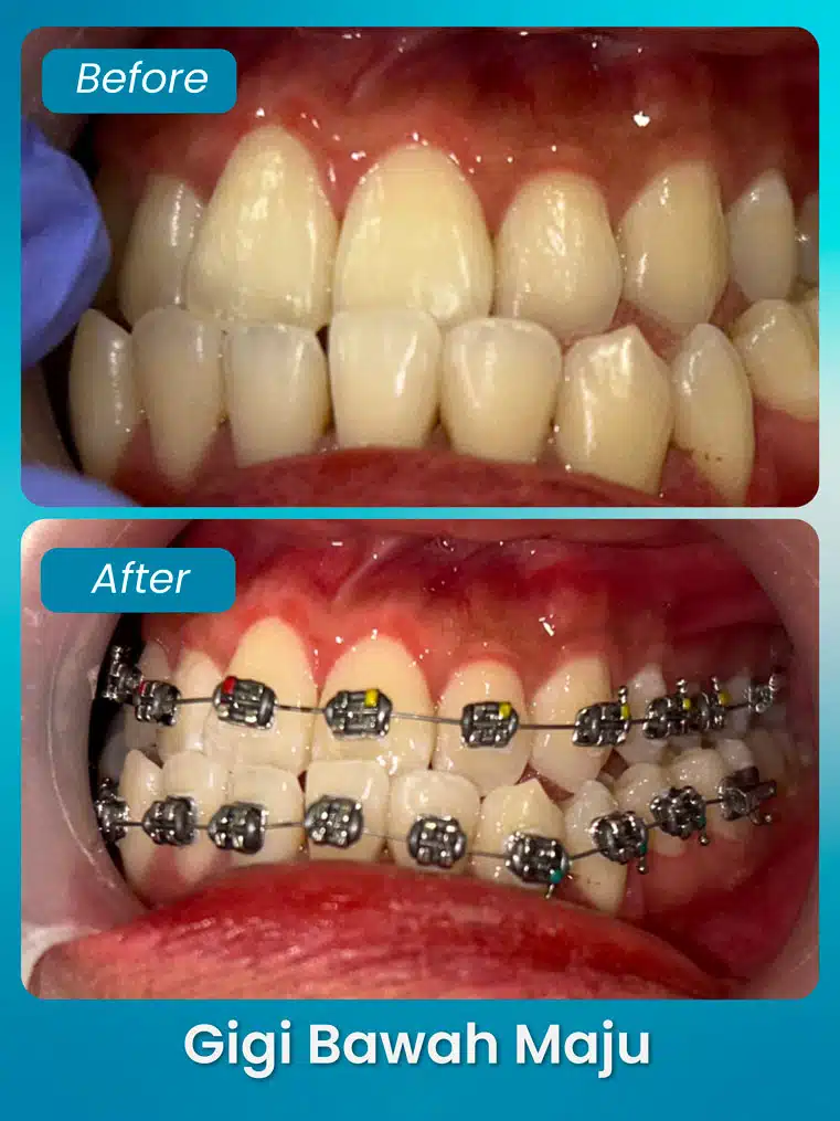 masalah gigi bawah maju - xpert by sozo dental