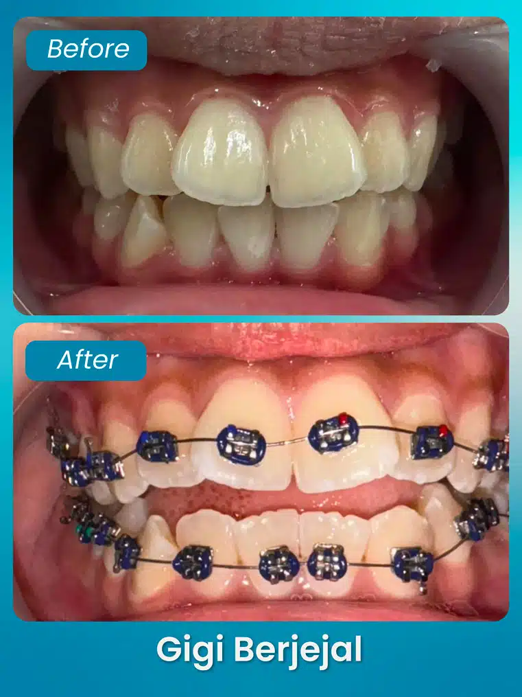 masalah gigi berjejal - xpert by sozo dental