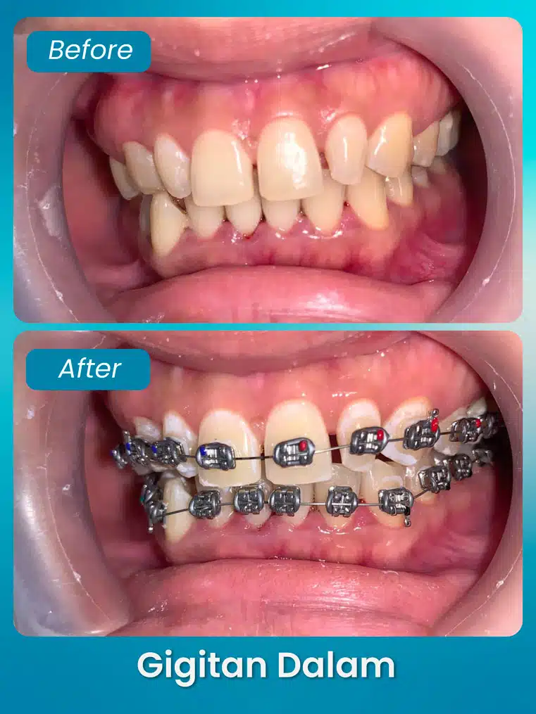 masalah gigitan dalam - xpert by sozo dental