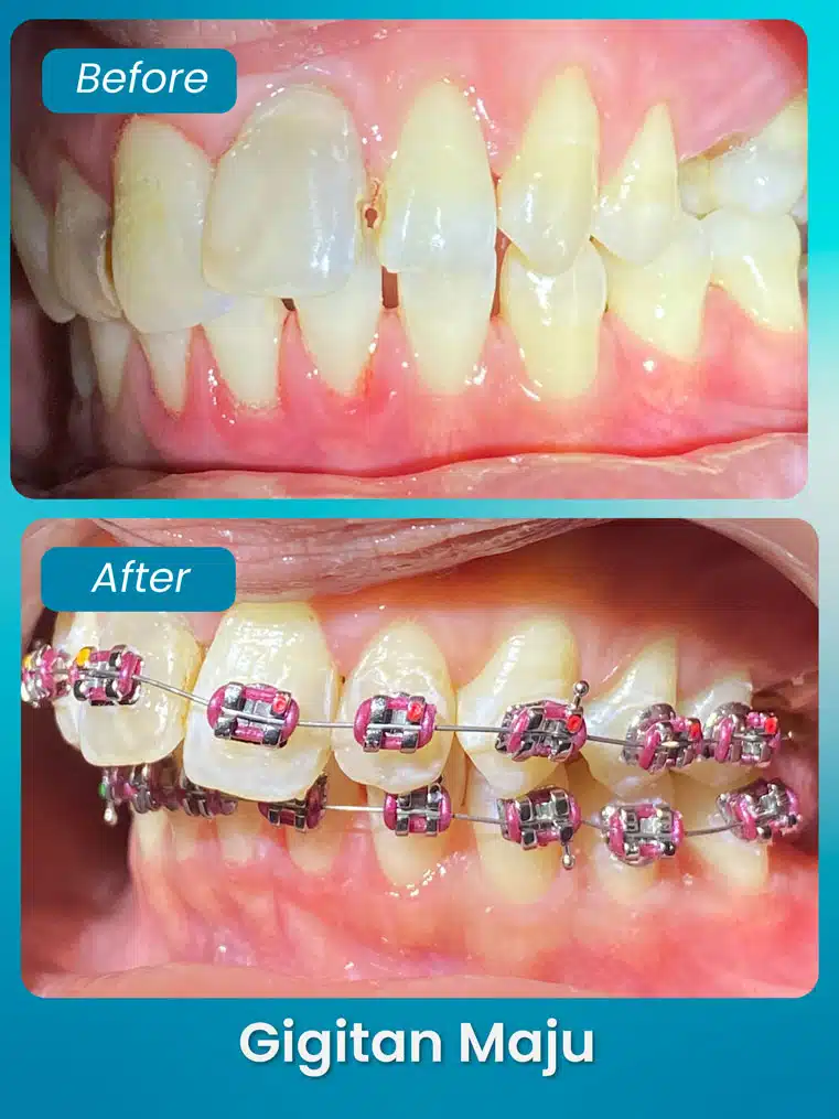 masalah gigitan maju - xpert by sozo dental