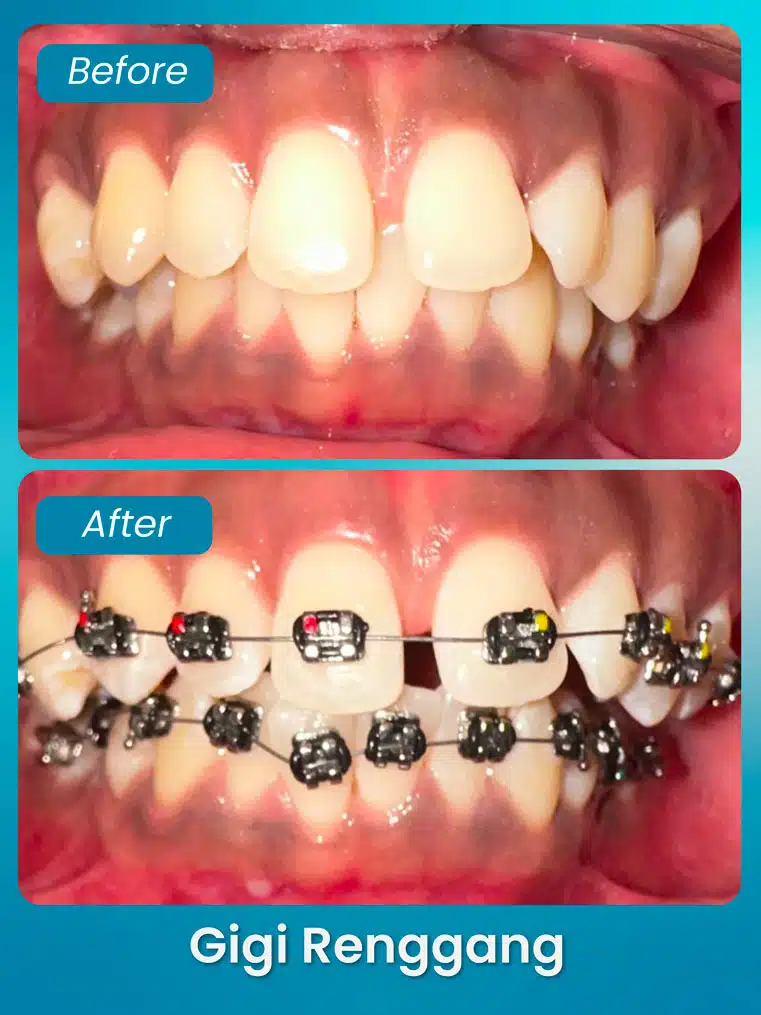 masalah gigitan renggang - xpert by sozo dental