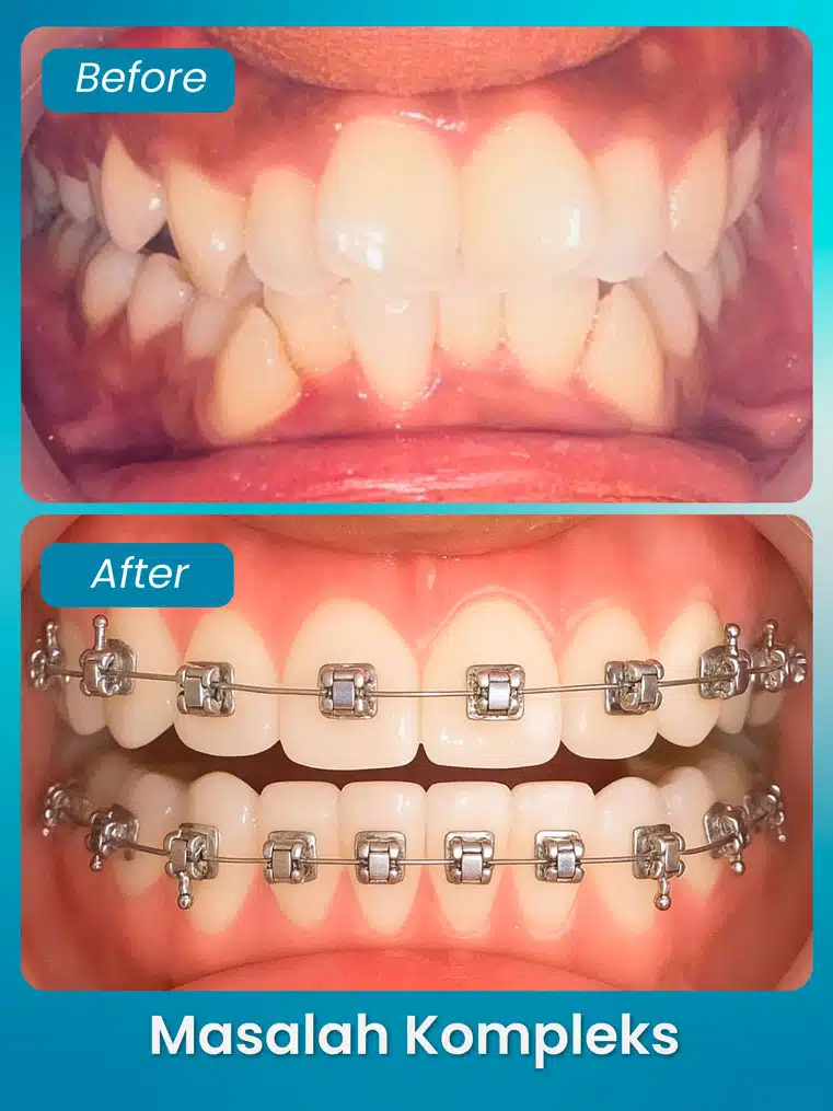masalah kompleks 1 - xpert by sozo dental