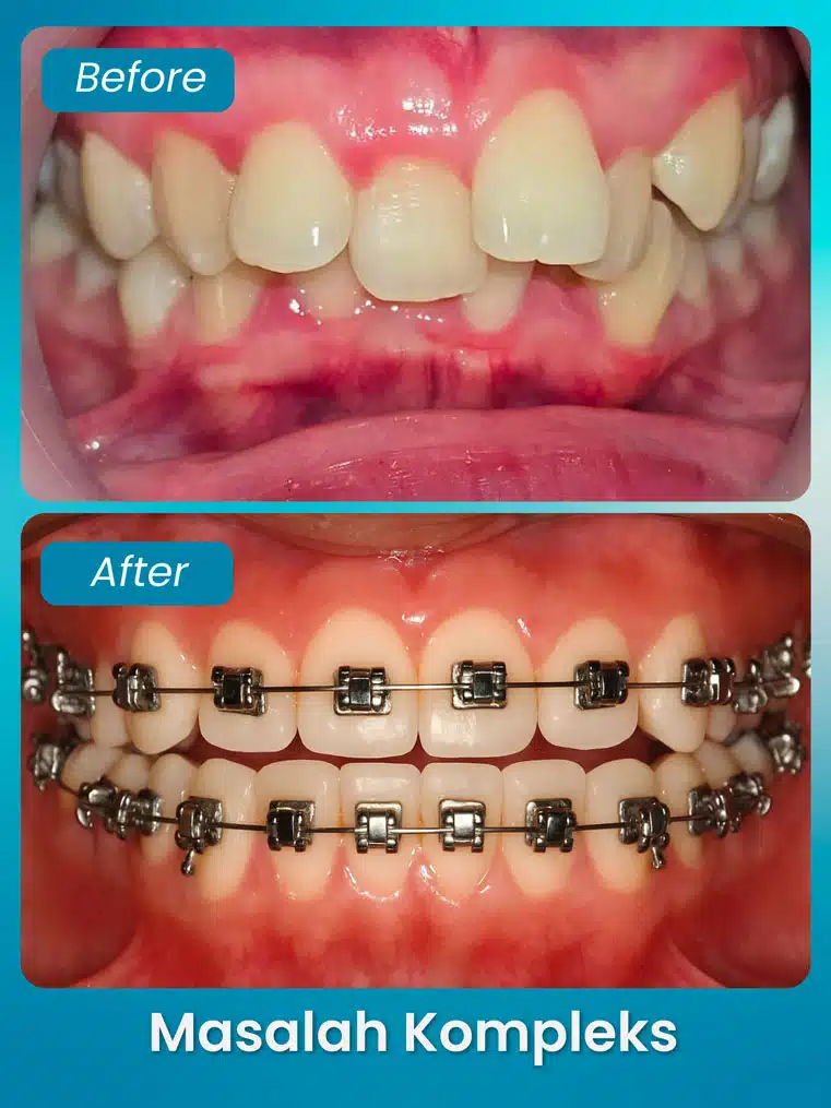 masalah kompleks 3 - xpert by sozo dental