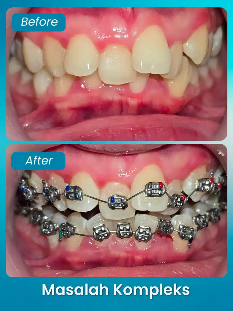 masalah kompleks 4 - xpert by sozo dental
