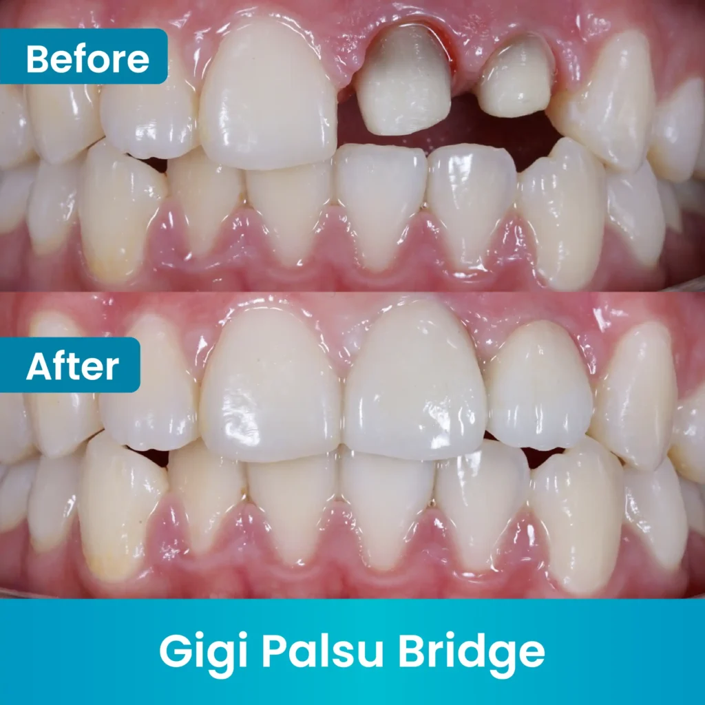 Before After_Gigi Palsu 2
