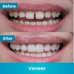 before after veneer 4
