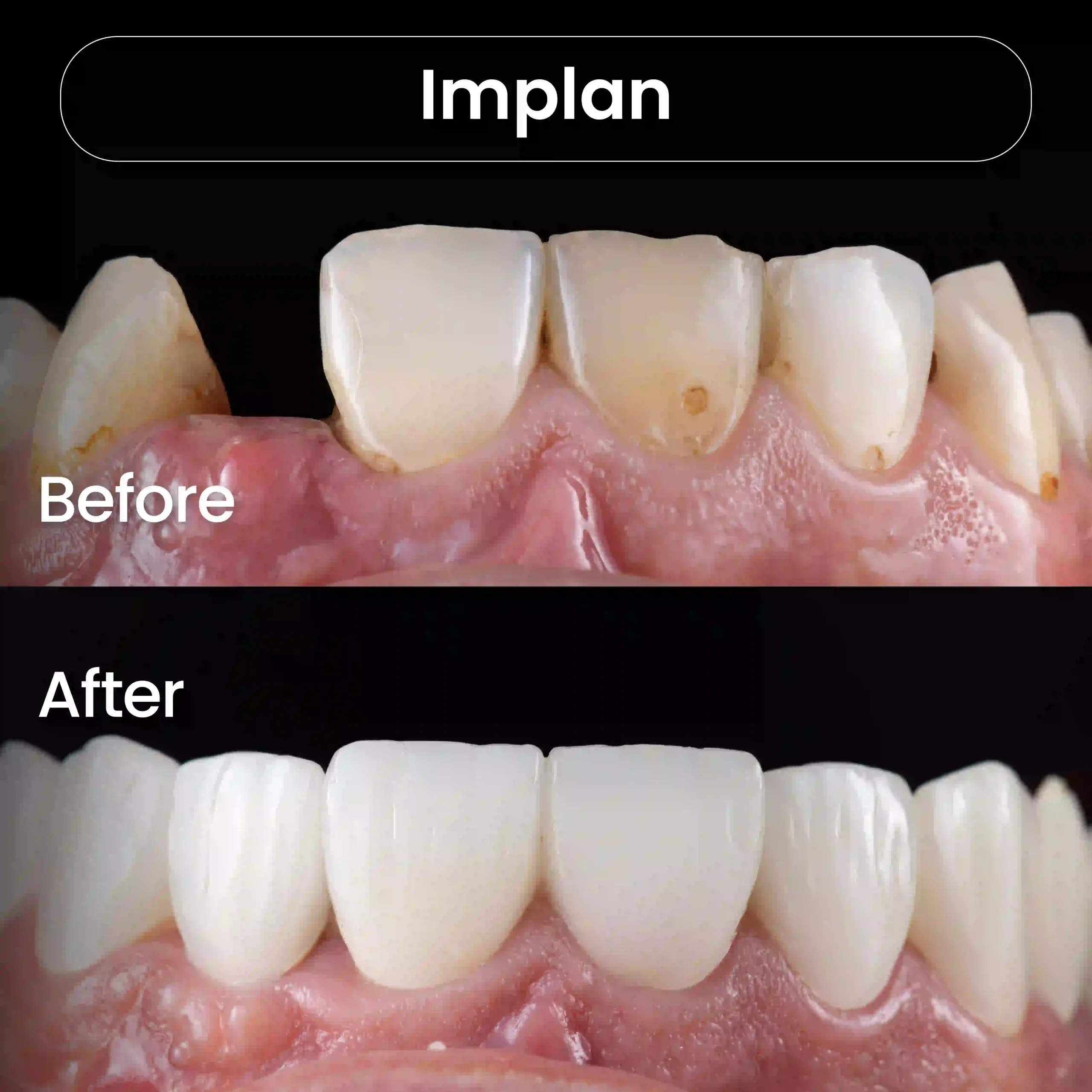 Before-After-SIA_Implan-1-1-scaled.webp