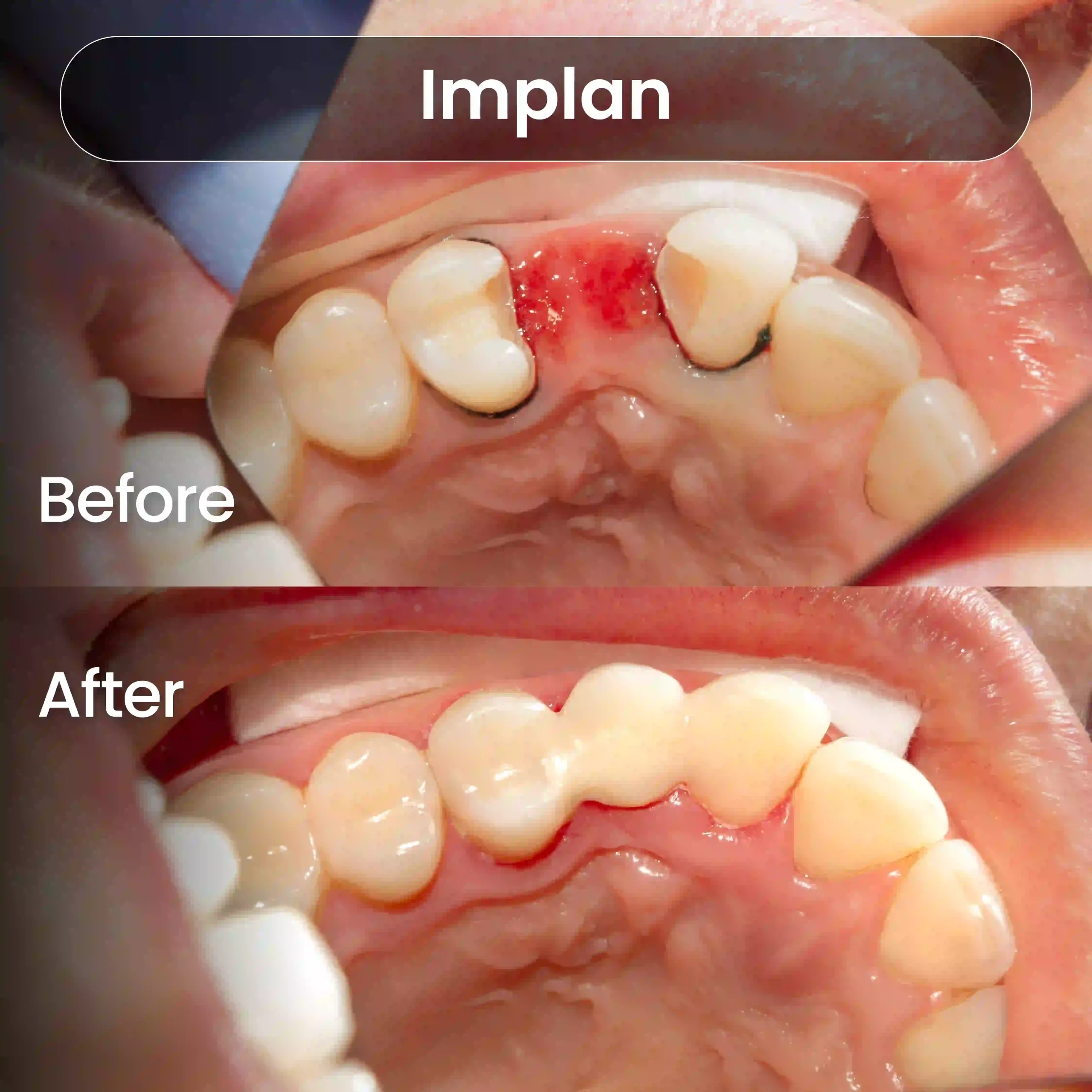 Before-After-SIA_Implan-2-1-scaled.webp