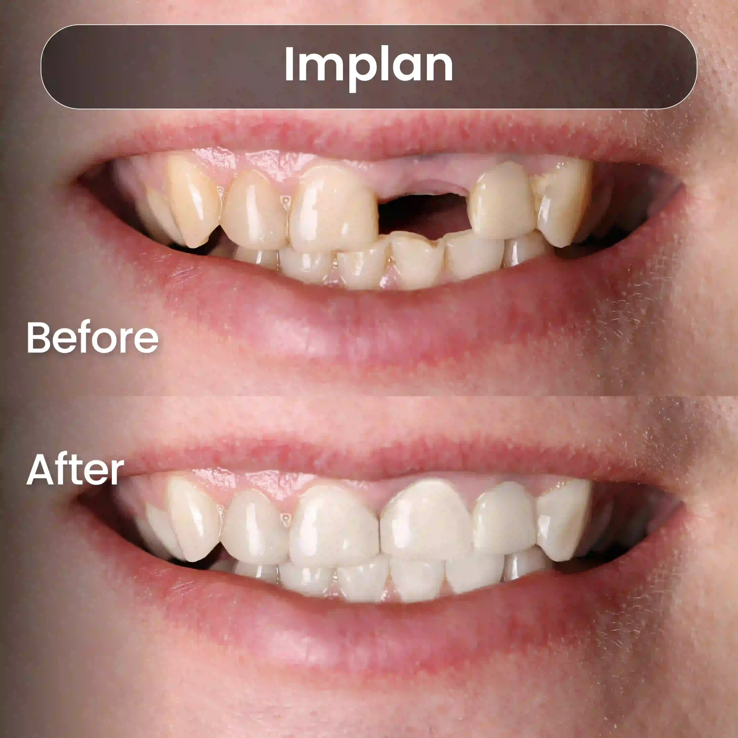 Before-After-SIA_Implan-4-1-scaled.webp