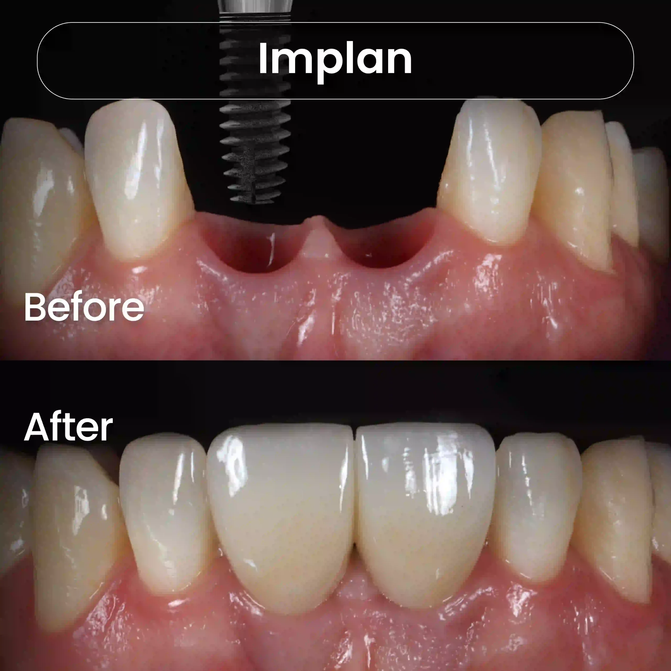 Before-After-SIA_Implan-5-1-scaled.webp