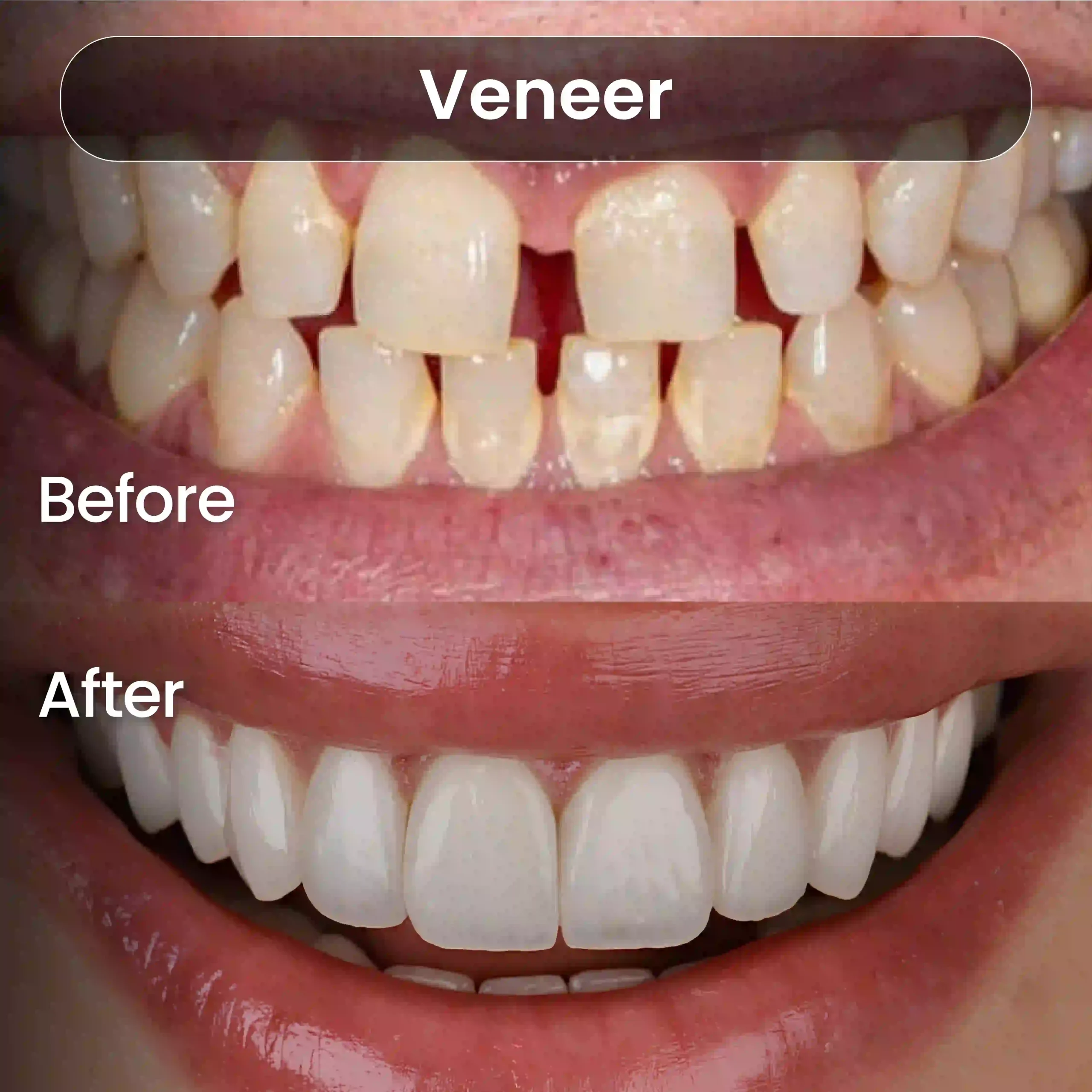 Before-After-SIA_Veneer-1-1-scaled.webp