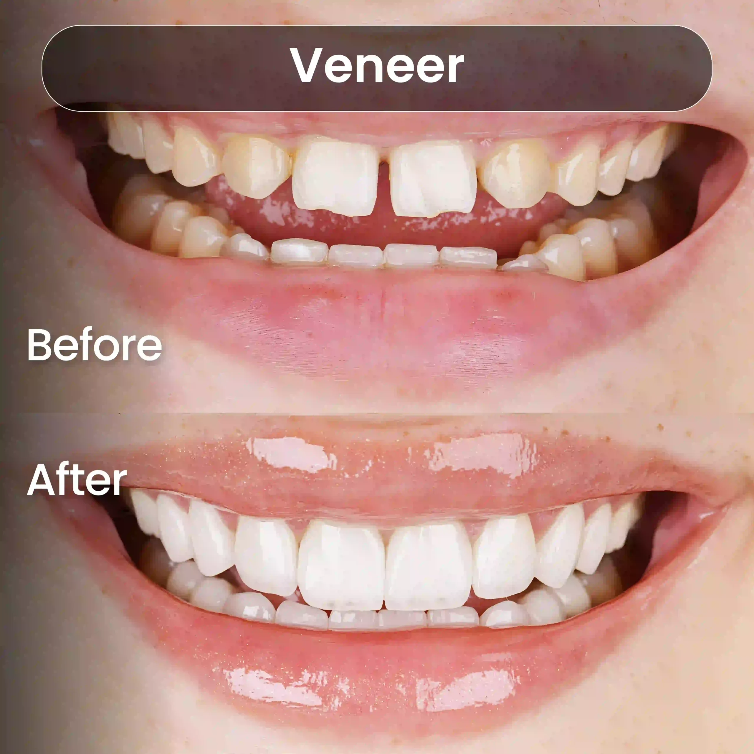 Before-After-SIA_Veneer-2-1-scaled.webp