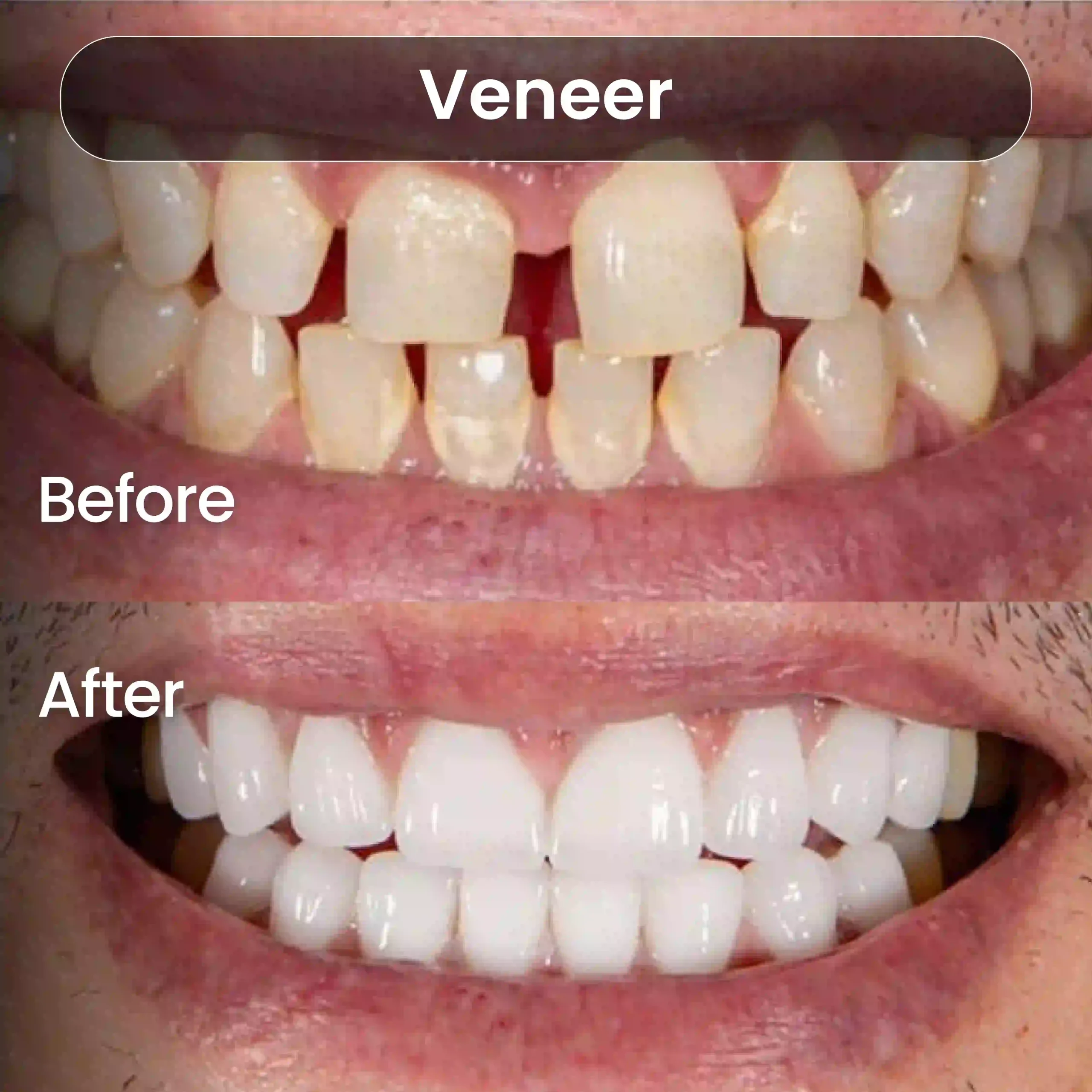 Before-After-SIA_Veneer-3-1-scaled.webp