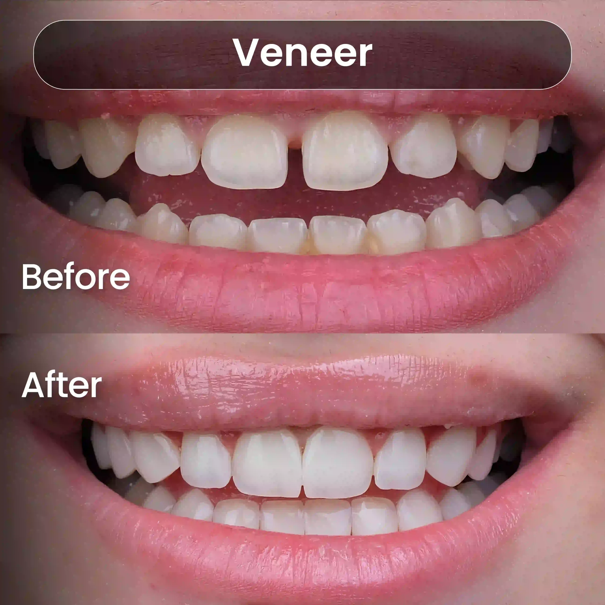 Before-After-SIA_Veneer-4-1-scaled.webp