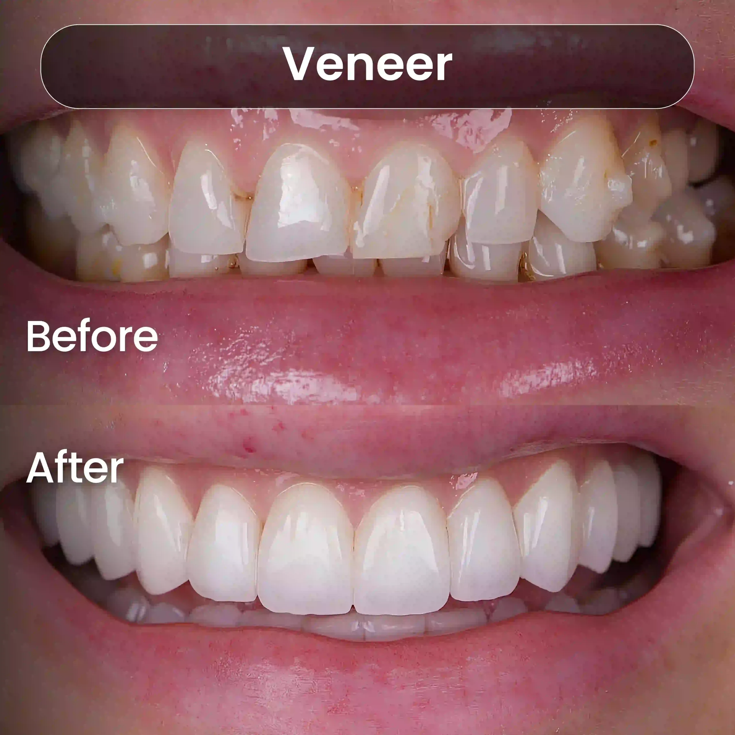 Before-After-SIA_Veneer-5-1-scaled.webp