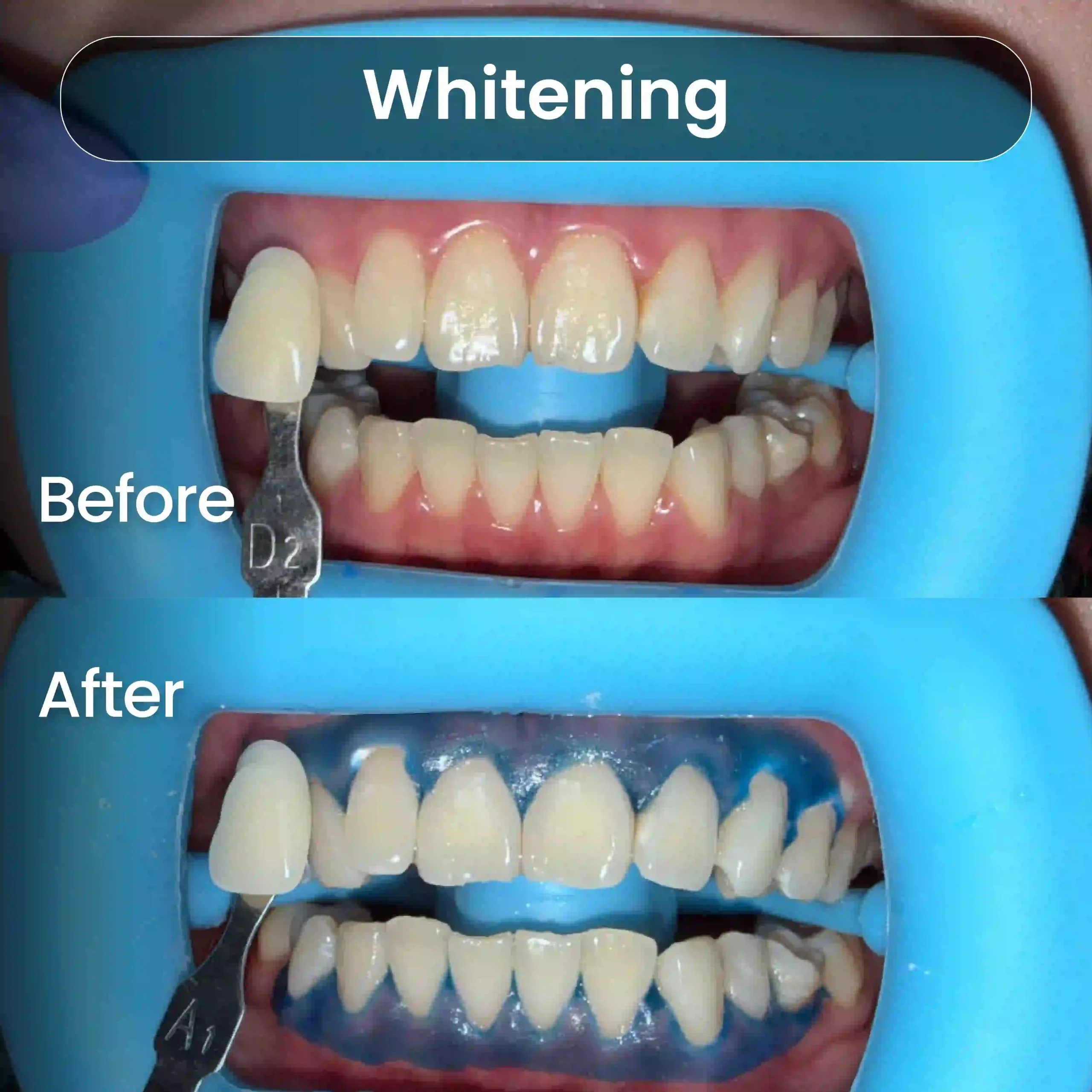 Before-After-SIA_Whitening-1-1-scaled.webp