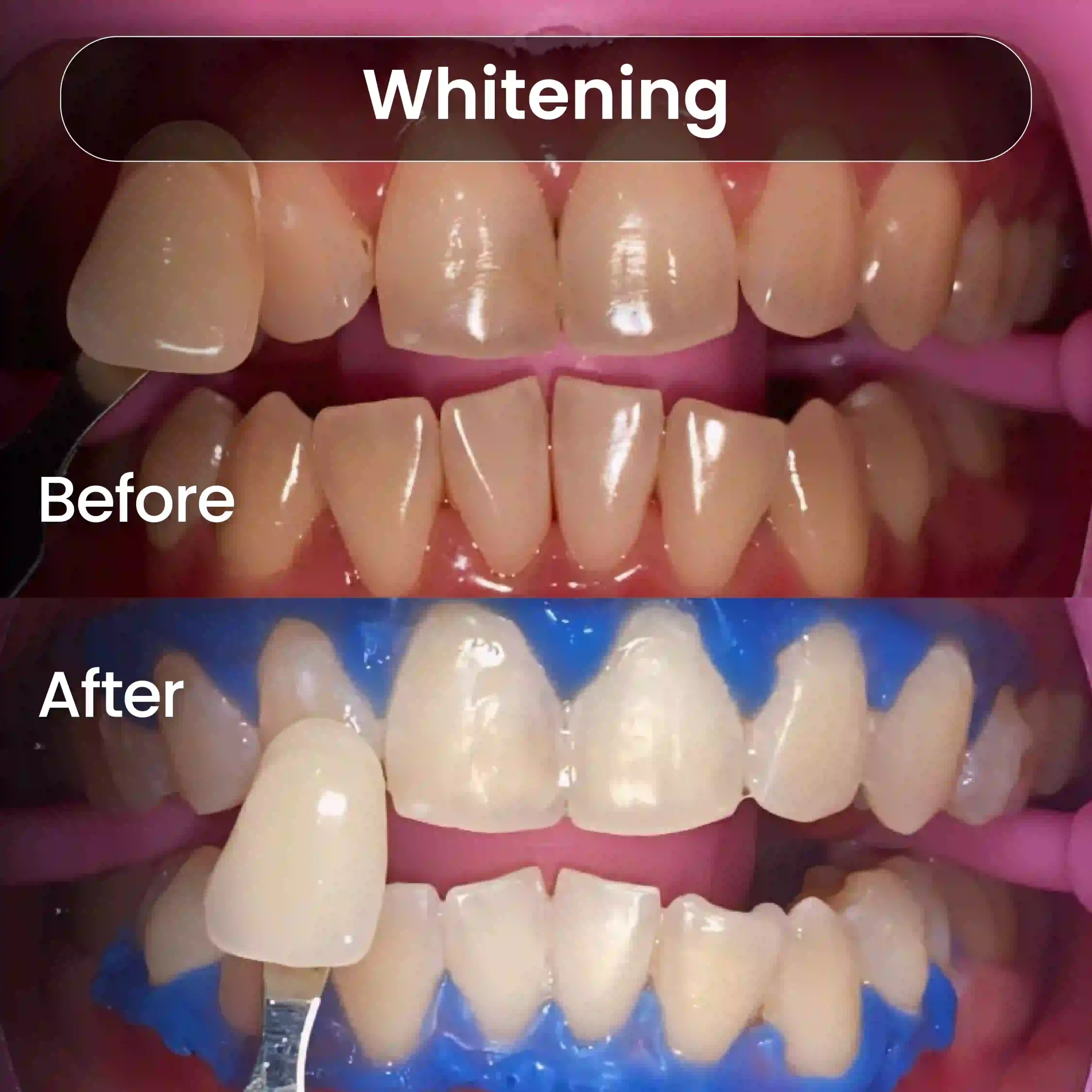 Before-After-SIA_Whitening-2-1-scaled.webp