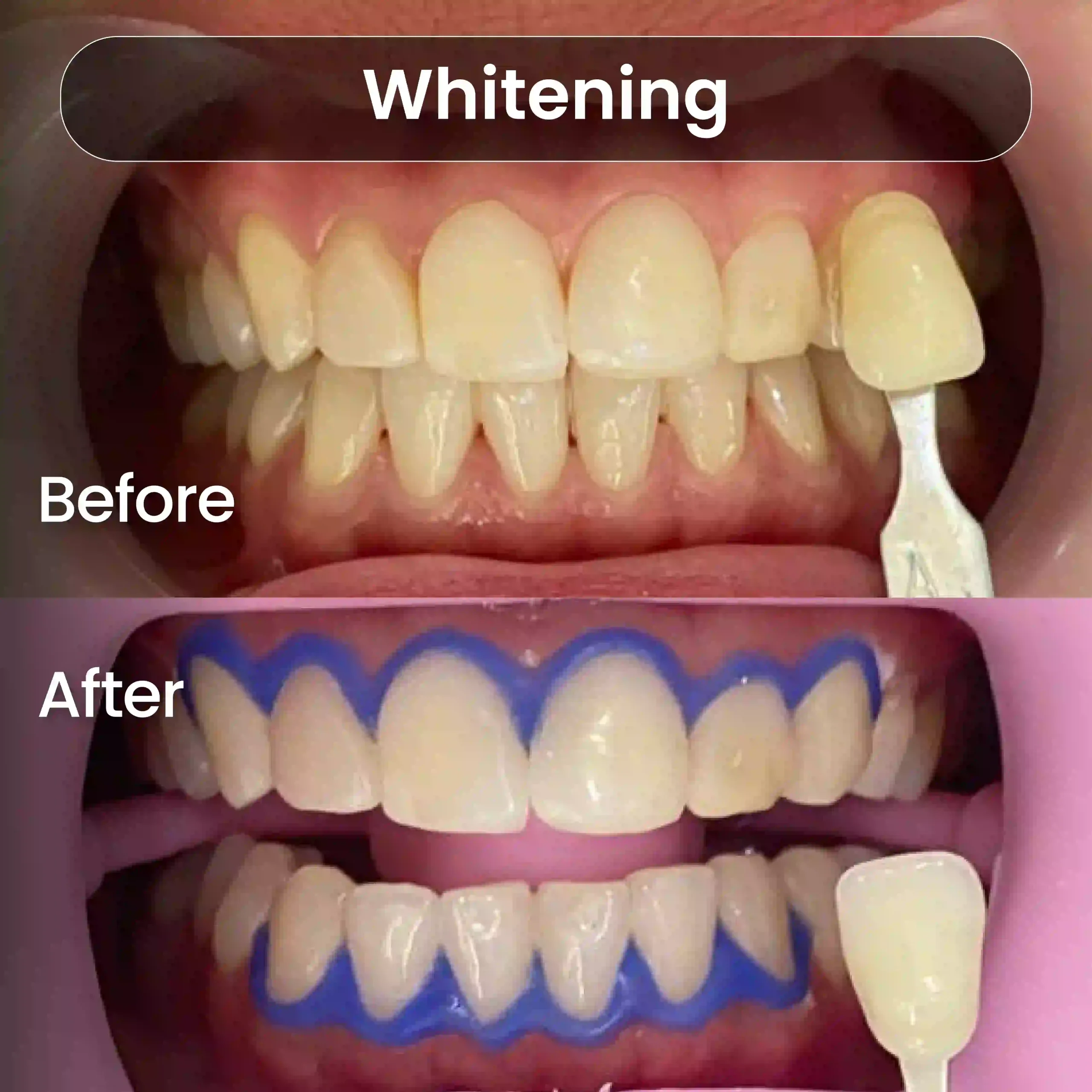 Before-After-SIA_Whitening-3-1-scaled.webp