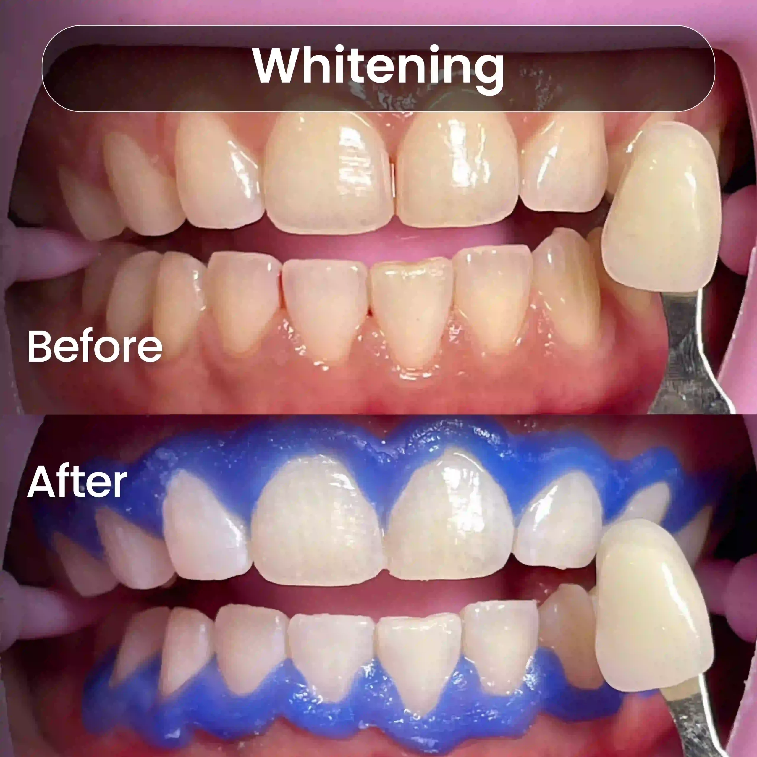 Before-After-SIA_Whitening-4-1-scaled.webp