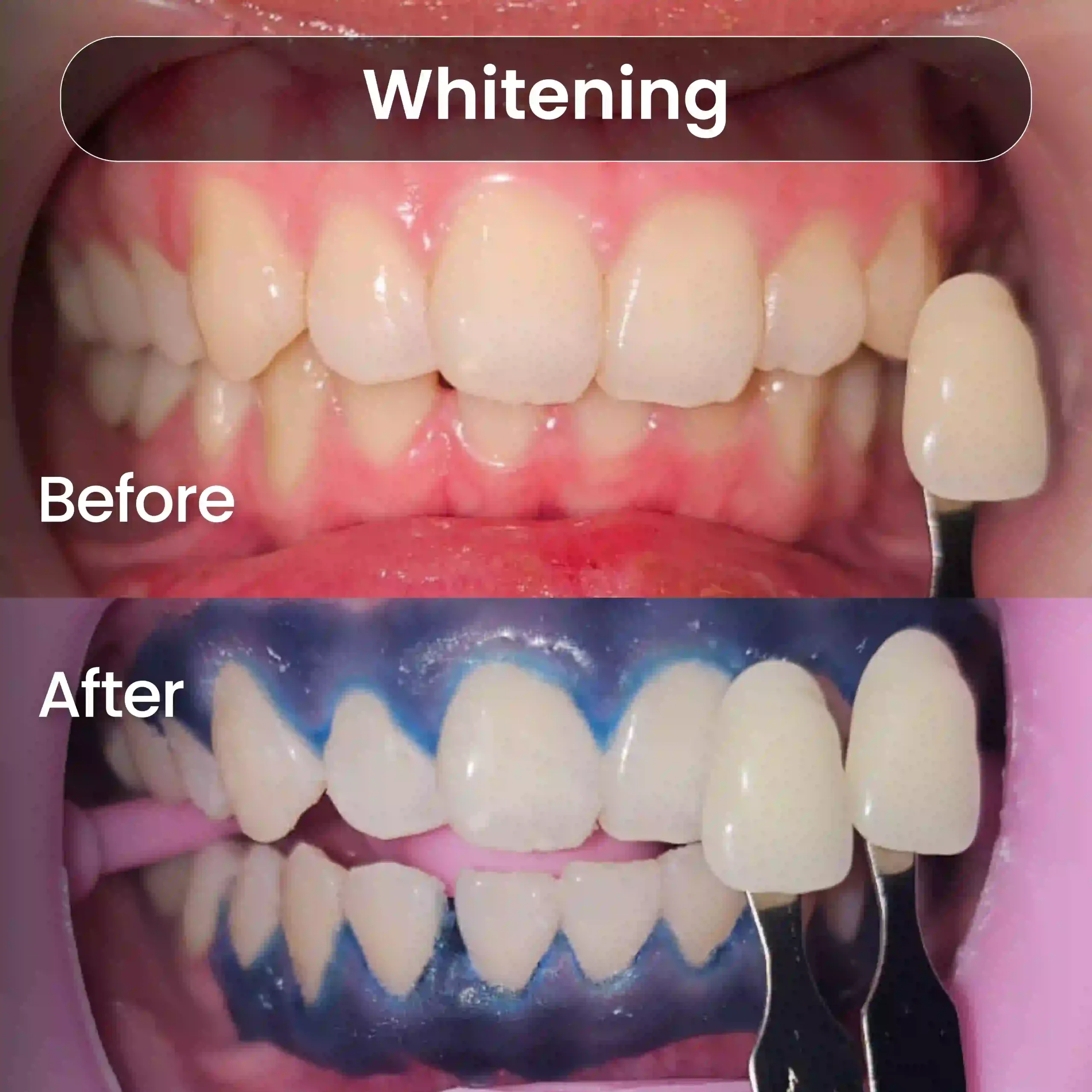 Before-After-SIA_Whitening-5-1-scaled.webp