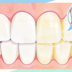 Ketahui Terbentuknya Plak Gigi, Bahaya & Cara Menghindari