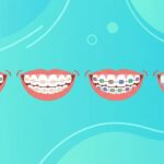 Macam-macam Behel Gigi beserta Gambarnya & Cara Pilih yang Tepat