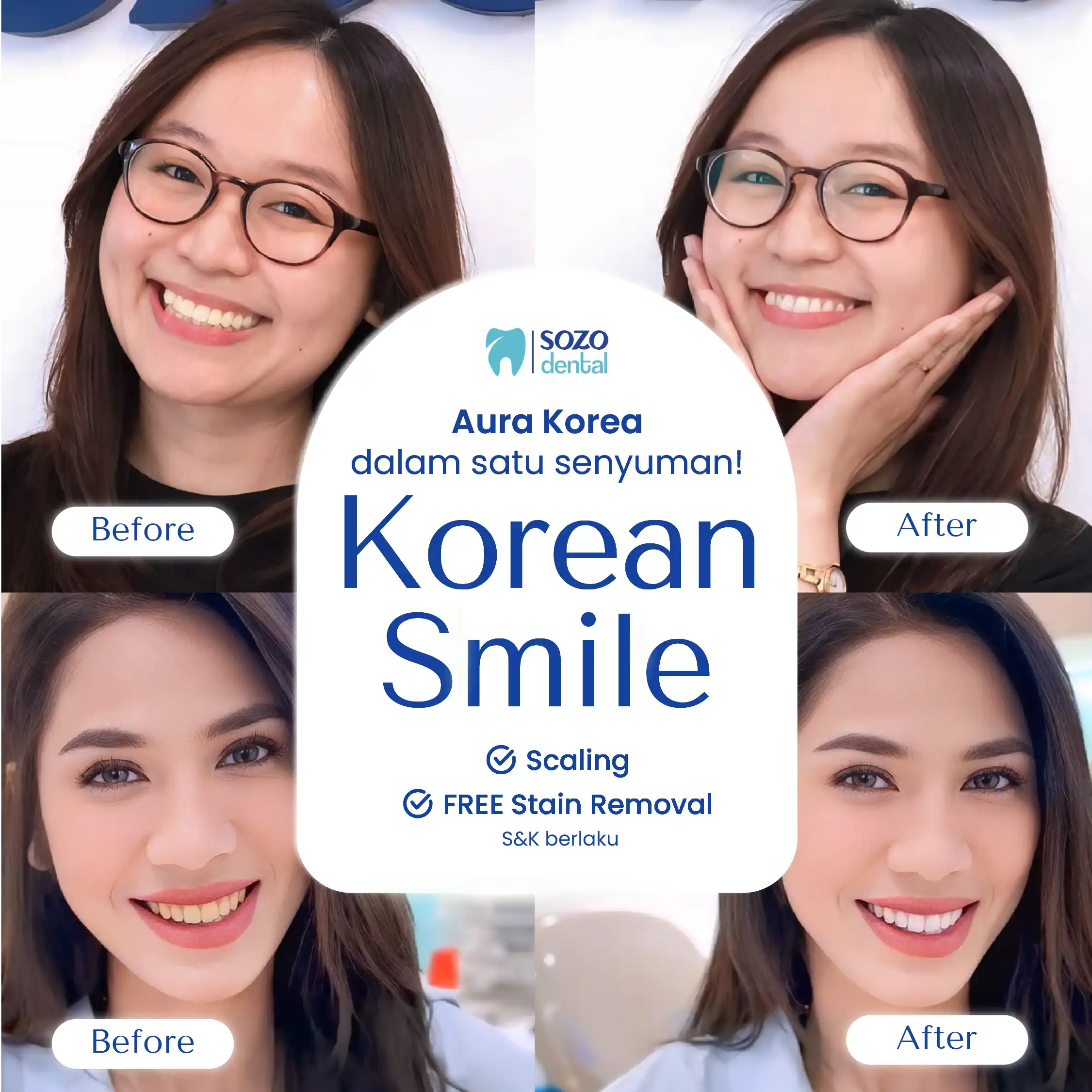 biaya scaling gigi - korean smile - klinik gigi sozo dental