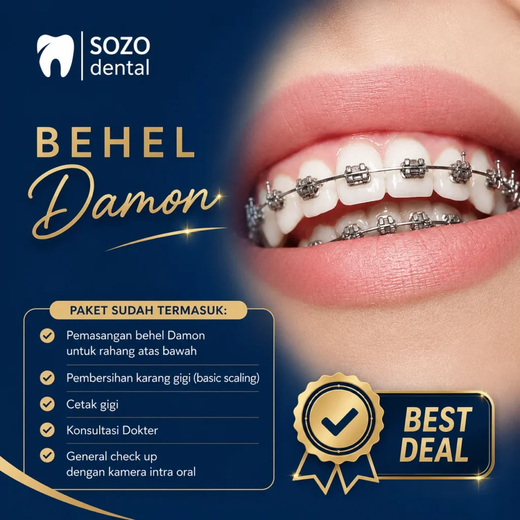 harga behel self ligating - damon