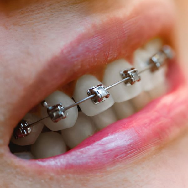 behel self ligating spesialis - sozo dental